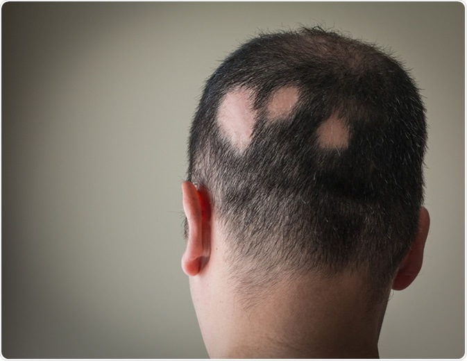 Alopecia Aerata - Image Credit: Alex Papp / Shutterstock